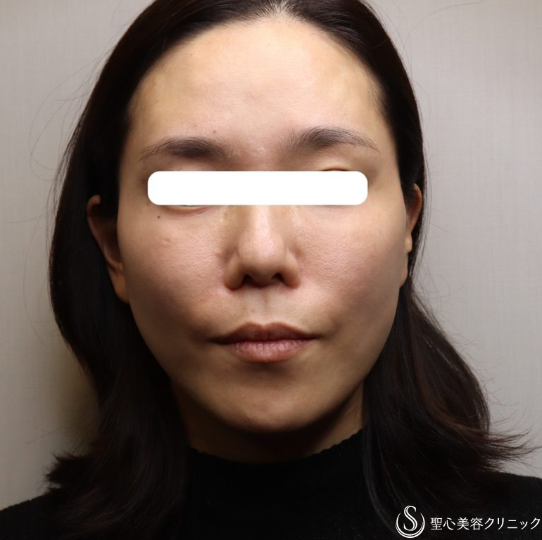 【女性・フェイスラインをすっきりと】TESSリフト（施術直後と翌日） After 