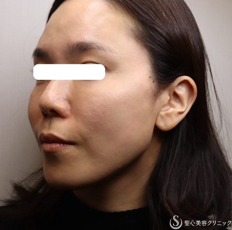 【女性・フェイスラインをすっきりと】TESSリフト（施術直後と翌日） After 