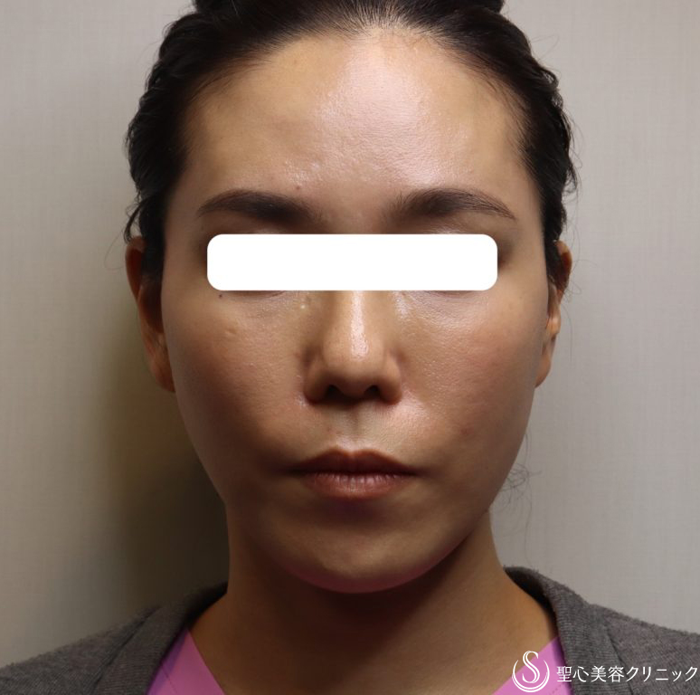 【女性・フェイスラインをすっきりと】TESSリフト（施術直後と翌日） After 