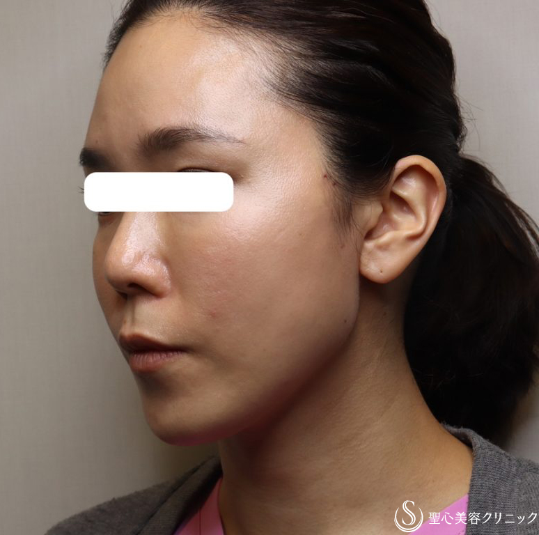 【女性・フェイスラインをすっきりと】TESSリフト（施術直後と翌日） After 