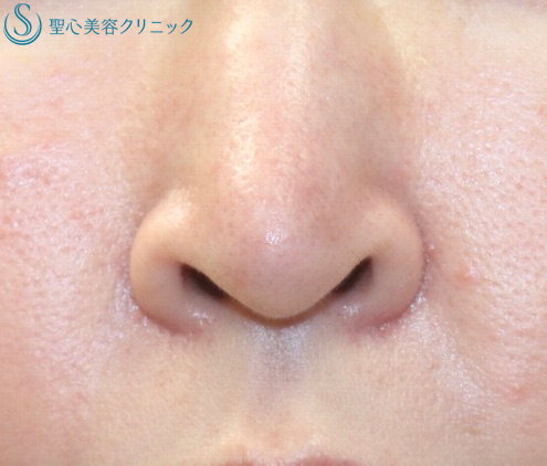 【鼻の穴が見えるのが気になる】鼻孔縁下降術（7日後） Before 