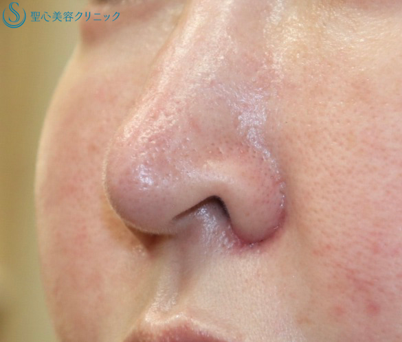 【鼻の穴が見えるのが気になる】鼻孔縁下降術（7日後） Before 