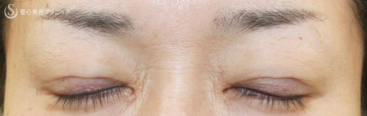 【40代女性・画期的な眼瞼下垂（埋没法）】切らない眼瞼下垂+α法（1年3ヶ月後） After 
