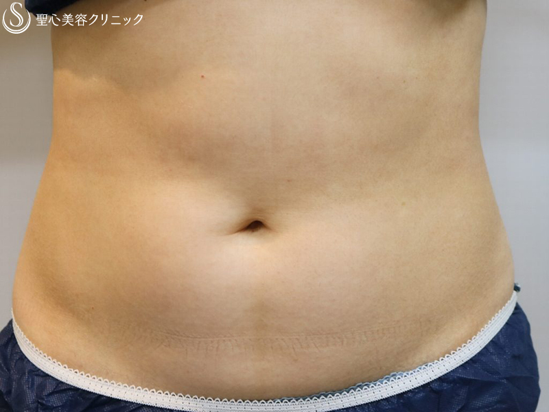 【30代女性・切らない痩身術】リポセル（1ヶ月半後） Before 
