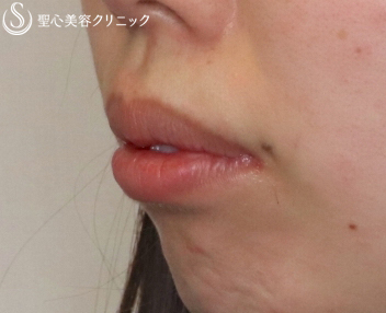 【20代女性・あひる口の可愛い唇に】スマイルリップ（プレミアム口角挙上とM字リップ）（1ヶ月後） Before 