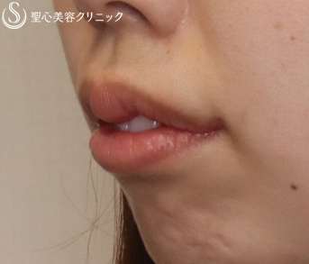 【20代女性・あひる口の可愛い唇に】スマイルリップ（プレミアム口角挙上とM字リップ）（1ヶ月後） After 