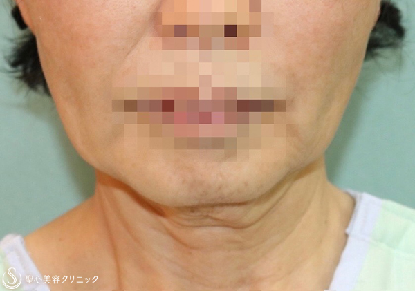 【70代女性・しっかりとリフトアップ】フェイスリフト（施術直後） Before 