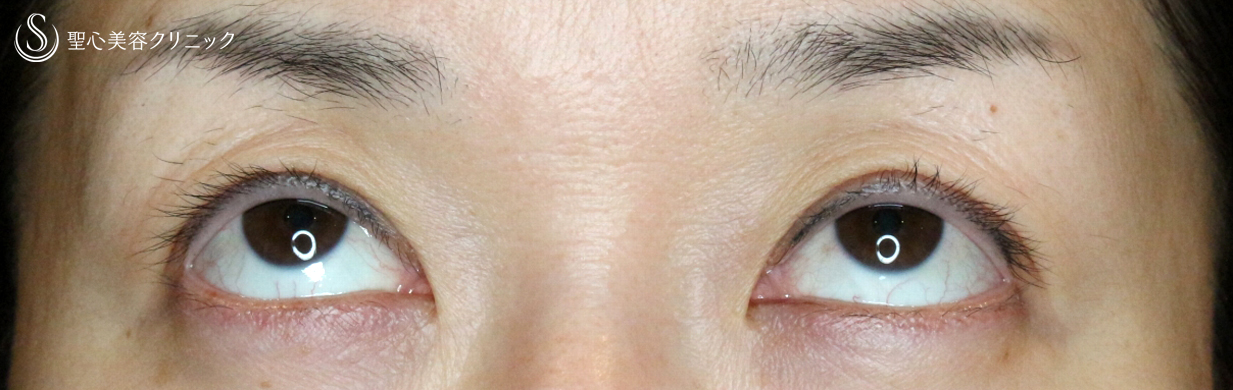 【40代女性・画期的な眼瞼下垂（埋没法）】切らない眼瞼下垂+α法（1年3ヶ月後） Before 