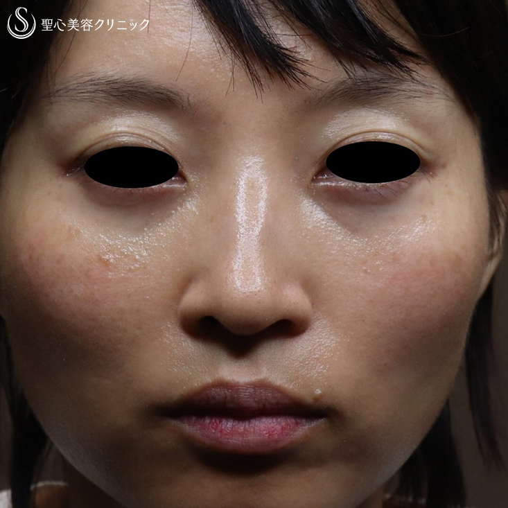 【30代女性・切らない目の下のクマ治療】プレミアムPRP皮膚再生療法（3ヶ月後） Before 