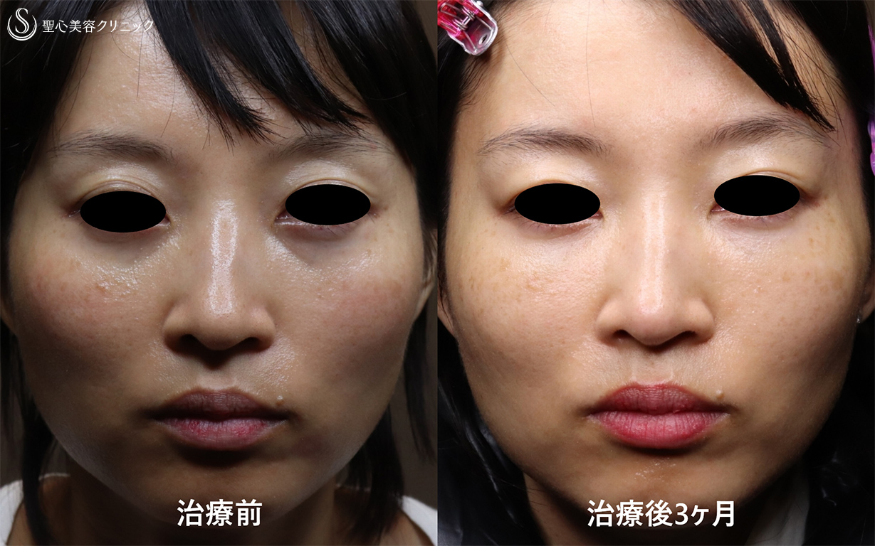 【30代女性・切らない目の下のクマ治療】プレミアムPRP皮膚再生療法（3ヶ月後） After 
