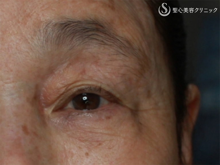 【70代女性・目の開きを改善】眼瞼下垂・埋没法（施術直後） Before 
