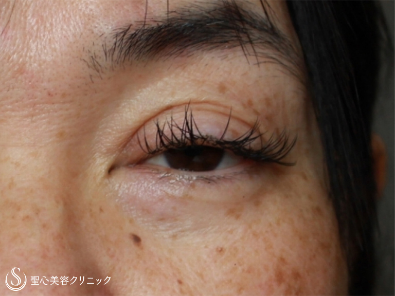 【50代女性・周りに気づかれずに治療したい】眼瞼下垂・埋没法（施術直後） Before 