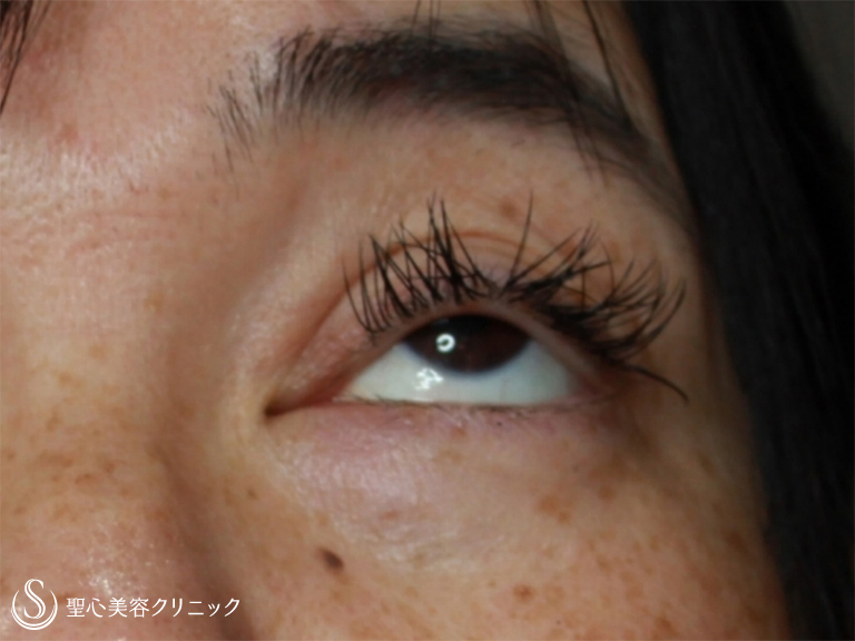 【50代女性・周りに気づかれずに治療したい】眼瞼下垂・埋没法（施術直後） Before 