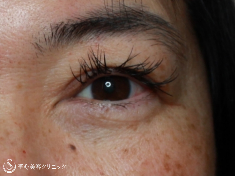 【50代女性・周りに気づかれずに治療したい】眼瞼下垂・埋没法（施術直後） After 