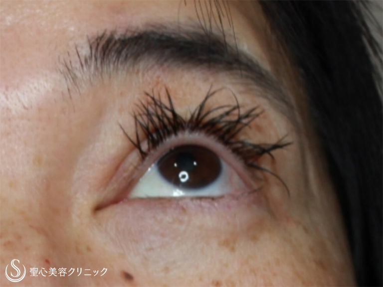 【50代女性・周りに気づかれずに治療したい】眼瞼下垂・埋没法（施術直後） After 