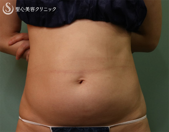 【40代女性・痩身】ベイザーリポ2.2脂肪吸引（術後2.5ヶ月） Before 