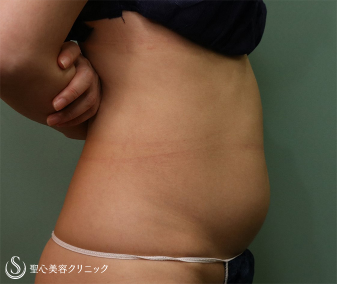 【40代女性・痩身】ベイザーリポ2.2脂肪吸引（術後2.5ヶ月） Before 