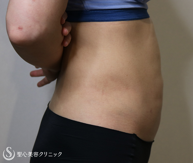 【40代女性・痩身】ベイザーリポ2.2脂肪吸引（術後2.5ヶ月） After 