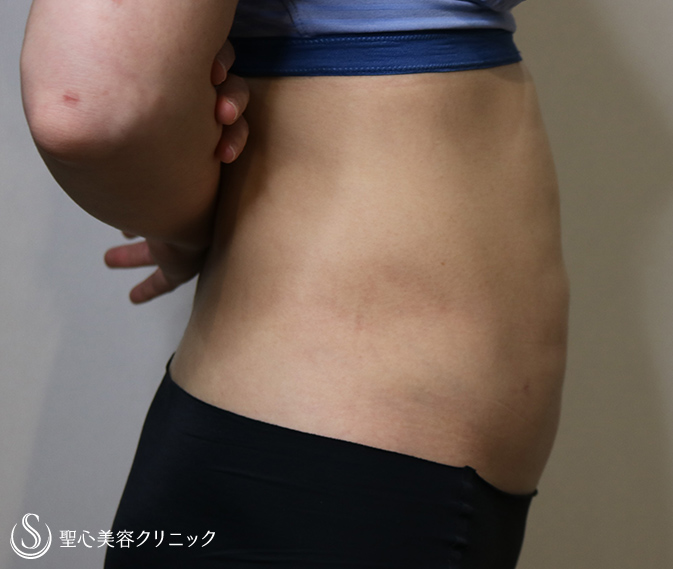 【40代女性・痩身】ベイザーリポ2.2脂肪吸引（術後2.5ヶ月） After 
