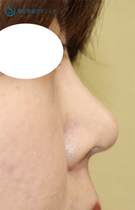 【20代女性・鼻筋をスッと長く、アップノーズも修正】鼻尖縮小術、耳介軟骨移植、プロテーゼ挿入（術後2ヶ月） After 