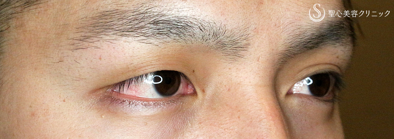 代男性 イケメンに磨きをかける マイクロメソッド A Pvdf 3点留め 2ヶ月後 症例写真 美容整形 美容外科なら聖心美容クリニック