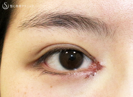 【20代女性・理想的なアーモンドアイ】目頭切開+α法 単独（術後5年の長期経過） Before 