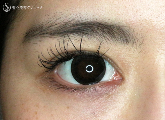 代女性 目頭だけでここまで変わる 目頭切開単独 術後2ヶ月 症例写真 美容整形 美容外科なら聖心美容クリニック 代女性 目頭だけでここまで変わる 目頭切開単独 術後2ヶ月 症例写真 美容整形 美容外科なら聖心美容クリニック