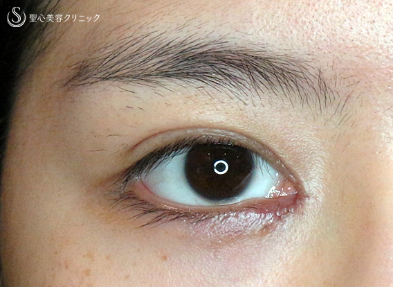 【20代女性・理想的なアーモンドアイ】目頭切開+α法 単独（術後5年の長期経過） After 