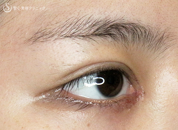 【20代女性・理想的なアーモンドアイ】目頭切開+α法 単独（術後5年の長期経過） After 