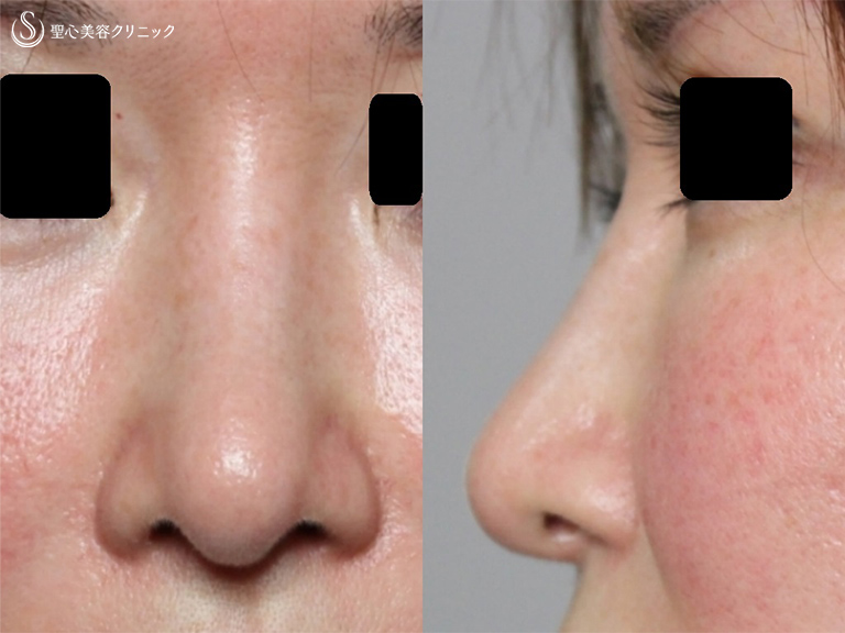 買い直営店 鼻形成術 = Aesthetic Rhinoplasty : 美容外科手術手技 健康/医学