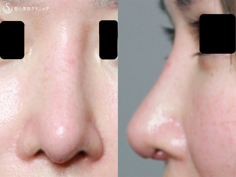 40代女性 鼻の複合手術 プロテーゼ入れ替え 鼻尖縮小 耳介軟骨移植 術後1ヶ月 症例写真 美容整形 美容外科なら聖心美容クリニック