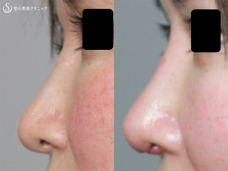 【40代女性・鼻の複合手術】プロテーゼ入れ替え、鼻尖縮小、耳介軟骨移植（術後1ヶ月） After 