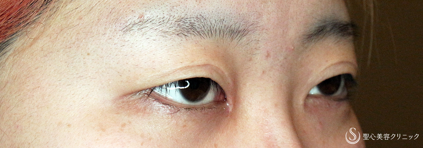 【20代女性・他院二重部分切開後の修正】二重全切開+α法「Ver.4」（5年後） Before 