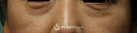 【40代女性・目の下のくま】プレミアムPRP皮膚再生療法（3ヶ月後） Before 
