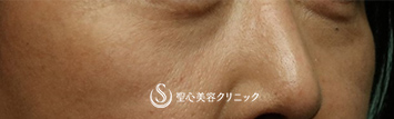 【40代女性・目の下のくま】プレミアムPRP皮膚再生療法（3ヶ月後） Before 
