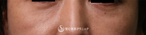【40代女性・目の下のくま】プレミアムPRP皮膚再生療法（3ヶ月後） After 