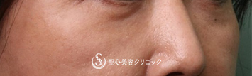 【40代女性・目の下のくま】プレミアムPRP皮膚再生療法（3ヶ月後） After 