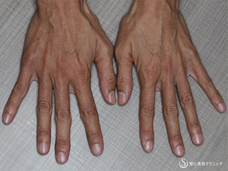 【40代女性・手の甲をふっくらさせたい】手の甲のプレミアムPRP皮膚再生療法（3ヶ月後） Before 