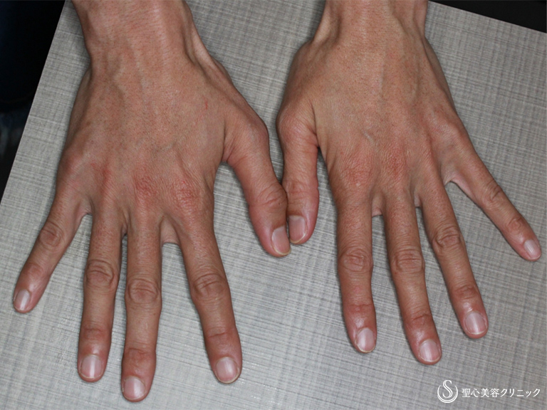 【40代女性・手の甲をふっくらさせたい】手の甲のプレミアムPRP皮膚再生療法（3ヶ月後） After 