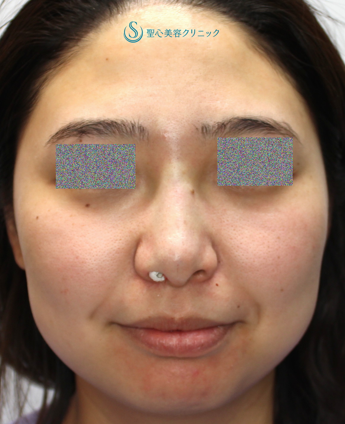 【20代女性・自然に鼻筋を通す】シリコンプロテーゼ（Ｉ型）による隆鼻術（1ヶ月後） After 