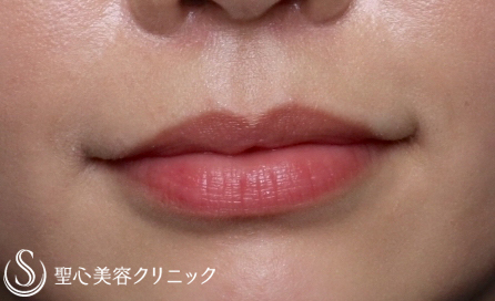 【20代女性・ヒアルロン酸で唇をふっくらと】スマイルリップ（1ヶ月後） Before 