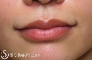 【20代女性・ヒアルロン酸で唇をふっくらと】スマイルリップ（1ヶ月後） After 