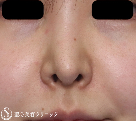 【20代女性・鼻の穴を目立たなくしたい】鼻孔縁下降術（１週間後） Before 