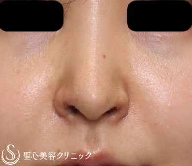 【20代女性・鼻の穴を目立たなくしたい】鼻孔縁下降術（１週間後） After 