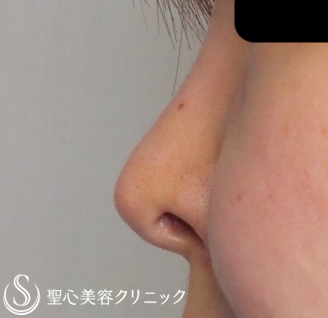 【20代女性・鼻の穴を目立たなくしたい】鼻孔縁下降術（１週間後） Before 