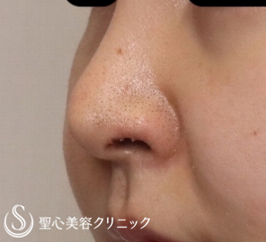 【20代女性・鼻の穴を目立たなくしたい】鼻孔縁下降術（１週間後） After 
