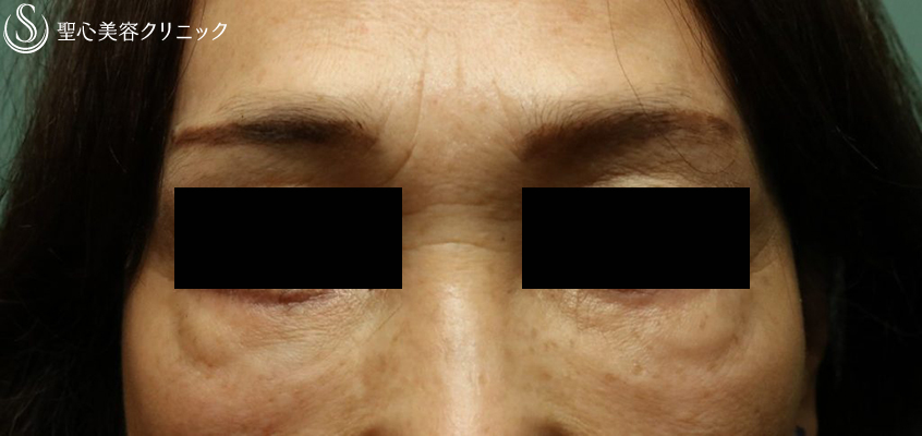 【60代女性・目の下の凹凸】プレミアムPRP皮膚再生療法（10ヶ月後） Before 