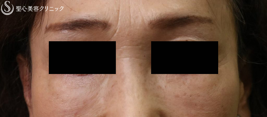 【60代女性・目の下の凹凸】プレミアムPRP皮膚再生療法（10ヶ月後） After 
