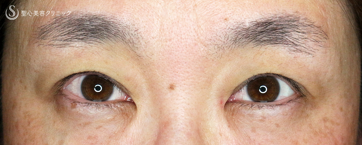 【40代女性・コンタクトレンズ下垂の第一選択】切らない眼瞼下垂+α法（4年後） Before 