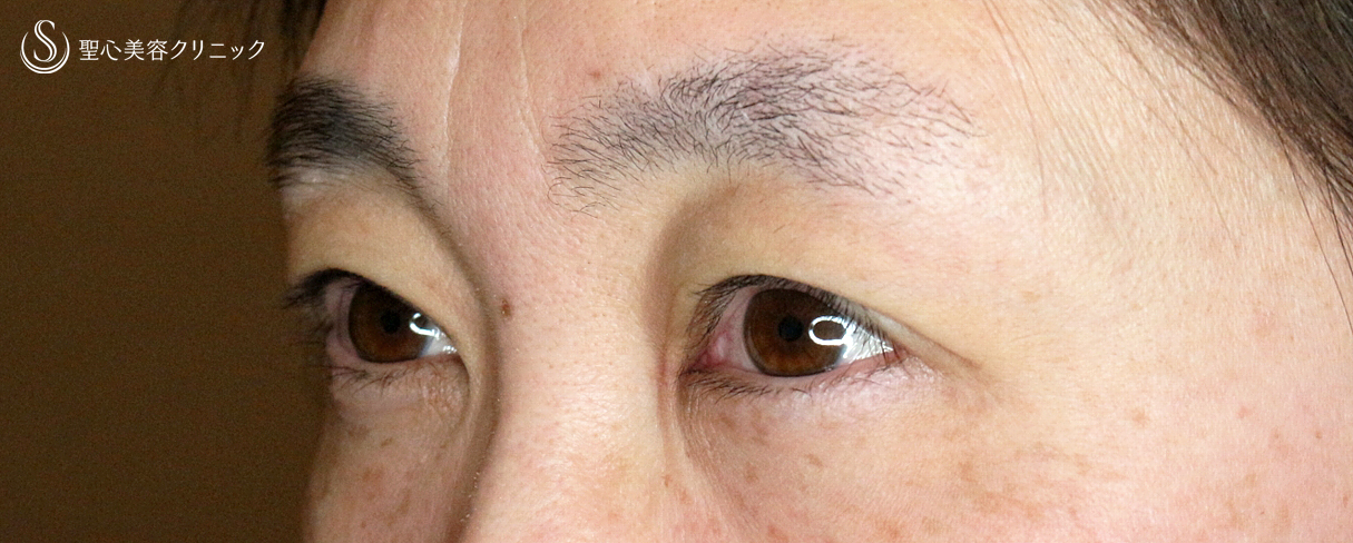 【40代女性・コンタクトレンズ下垂の第一選択】切らない眼瞼下垂+α法（4年後） Before 